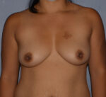 Breast Augmentation Implants