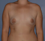 Breast Augmentation Implants