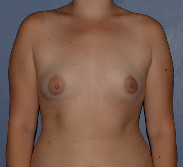 Breast Augmentation Implants