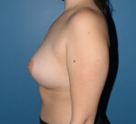 Breast Augmentation Implants