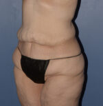 Tummy Tuck