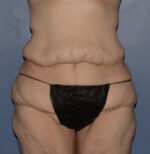 Tummy Tuck