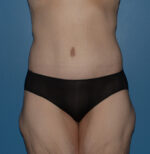Tummy Tuck
