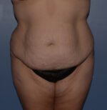 Tummy Tuck