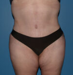 Tummy Tuck