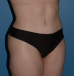 Tummy Tuck