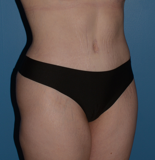 Tummy Tuck