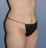 Tummy Tuck