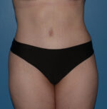 Tummy Tuck
