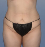 Tummy Tuck