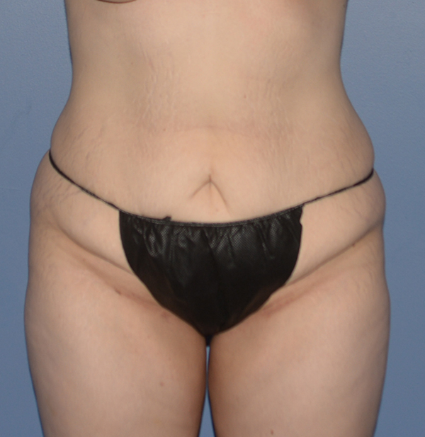 Tummy Tuck