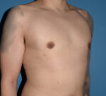 Male Breast Reduction