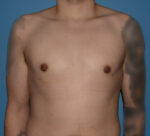 Male Breast Reduction