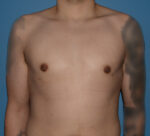 Male Breast Reduction