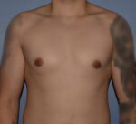 Male Breast Reduction