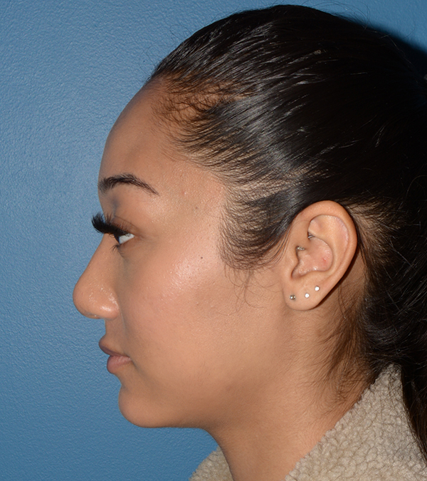 Rhinoplasty