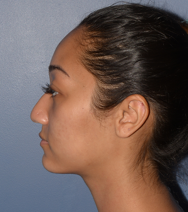 Rhinoplasty