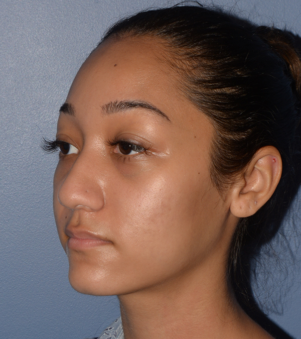 Rhinoplasty