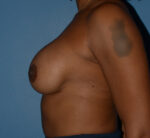 Breast Correction