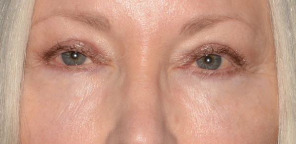 Eyelid Lift