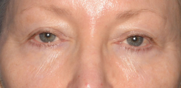 Eyelid Lift