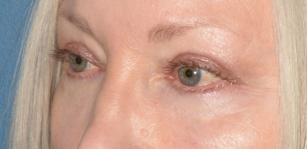 Eyelid Lift