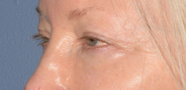 Eyelid Lift