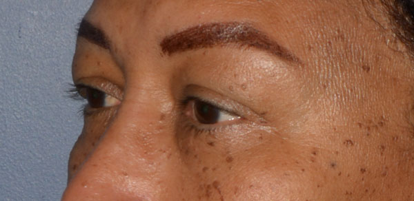 Eyelid Lift