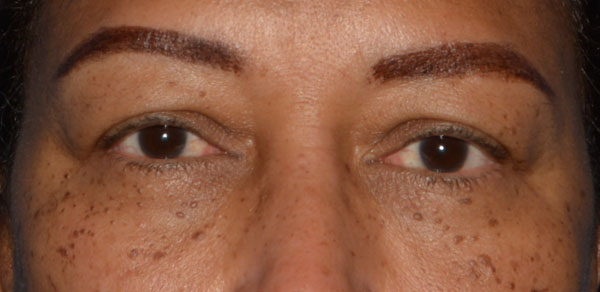 Eyelid Lift