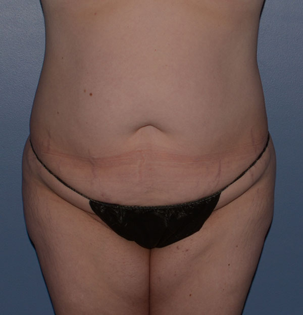 Tummy Tuck