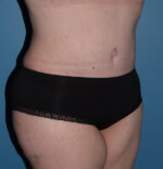 Tummy Tuck