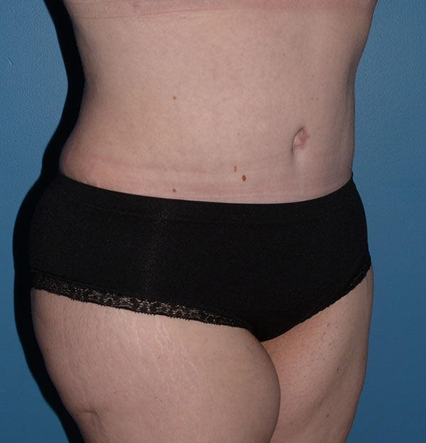 Tummy Tuck