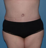 Tummy Tuck