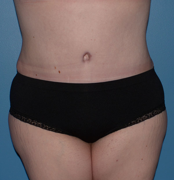 Tummy Tuck