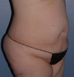 Tummy Tuck