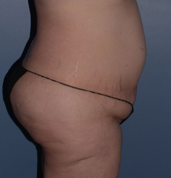 Tummy Tuck