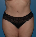 Tummy Tuck