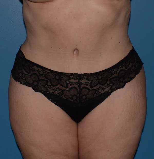Tummy Tuck