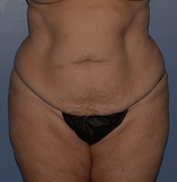 Tummy Tuck