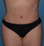 Tummy Tuck