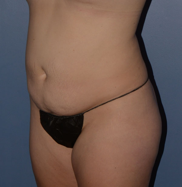 Tummy Tuck