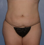 Tummy Tuck