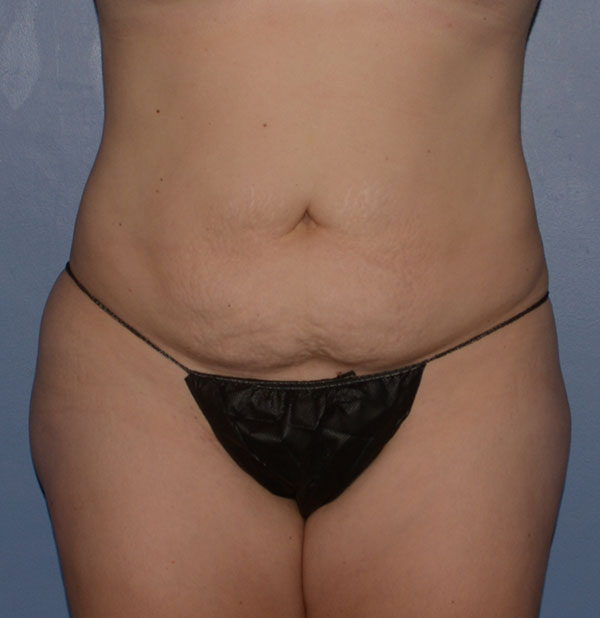 Tummy Tuck