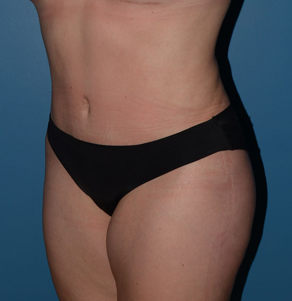 Tummy Tuck