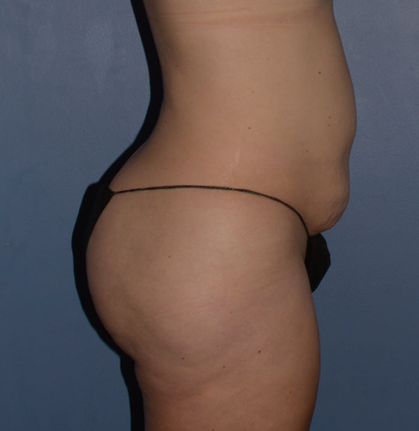 Tummy Tuck