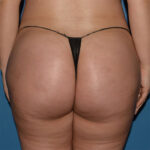 Brazilian Butt Lift