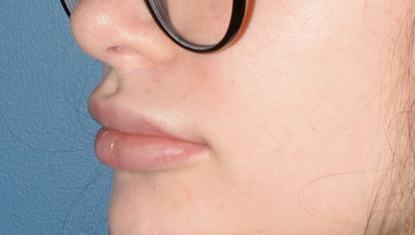 Lip Implants
