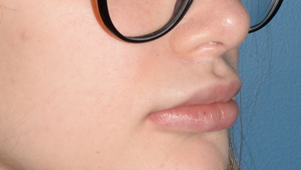 Lip Implants