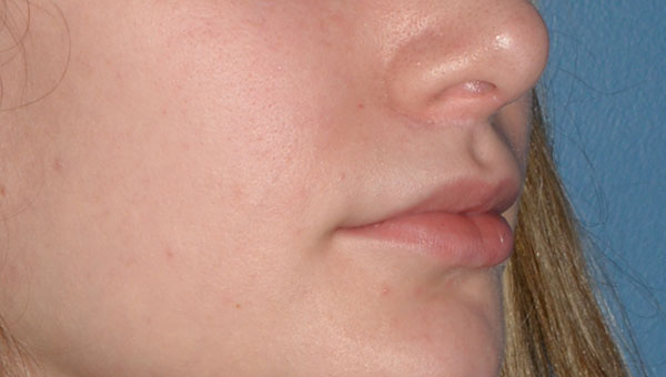 Lip Implants