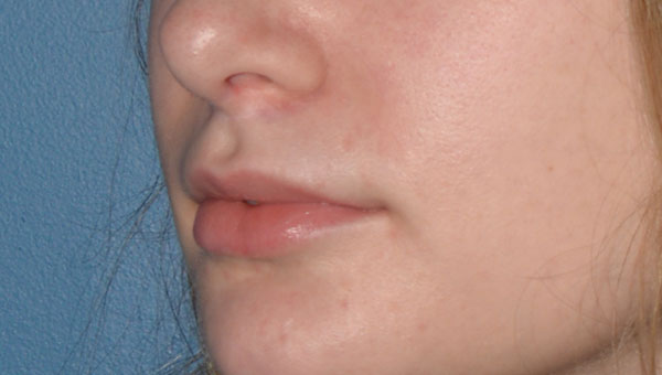 Lip Implants